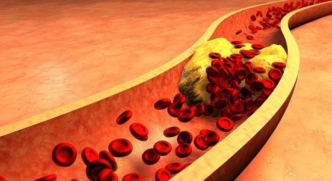 Como Reduzir colesterol das artérias
