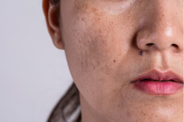 Manchas no rosto: aprenda a prevenir e amenizar esses sinais na pele